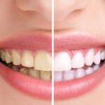 teeth-whitening