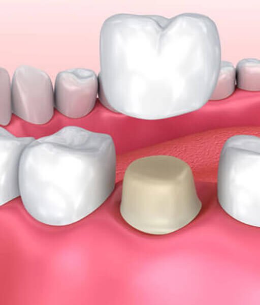 dental-crown