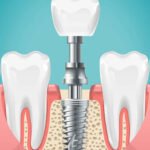 dental-implants