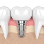 implantology