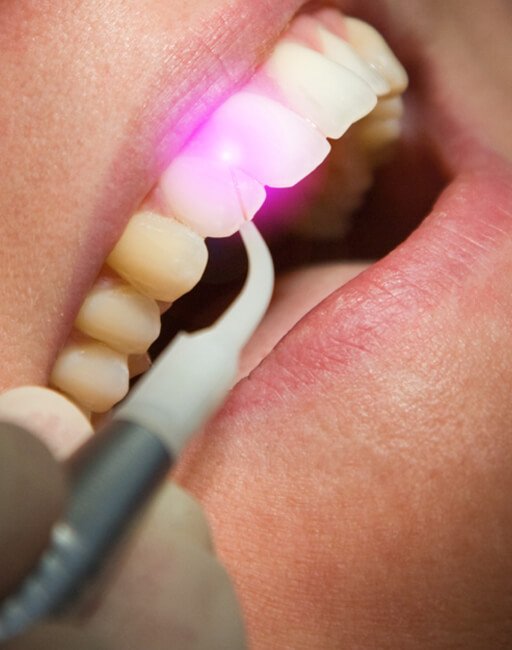 laser-gum-therapy